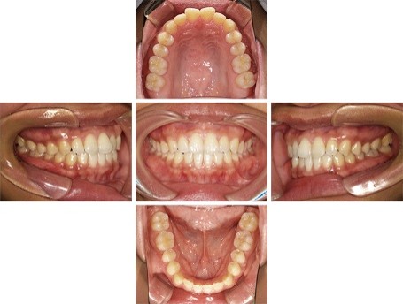 口腔内診査