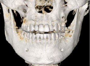 3D画像